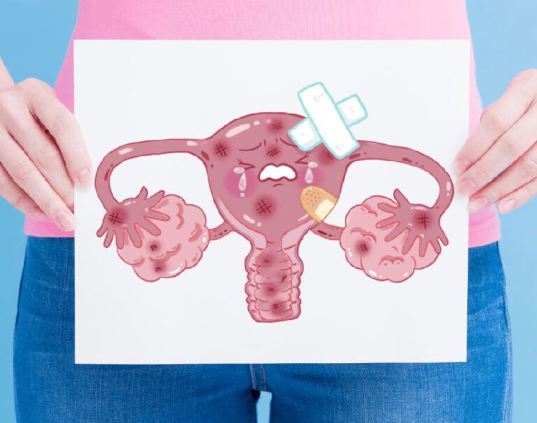 Endometriosis y la mejora de los estrógenos